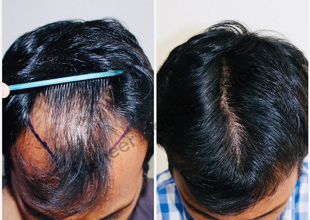 Hair Treatment
