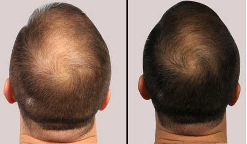 PRP therapy