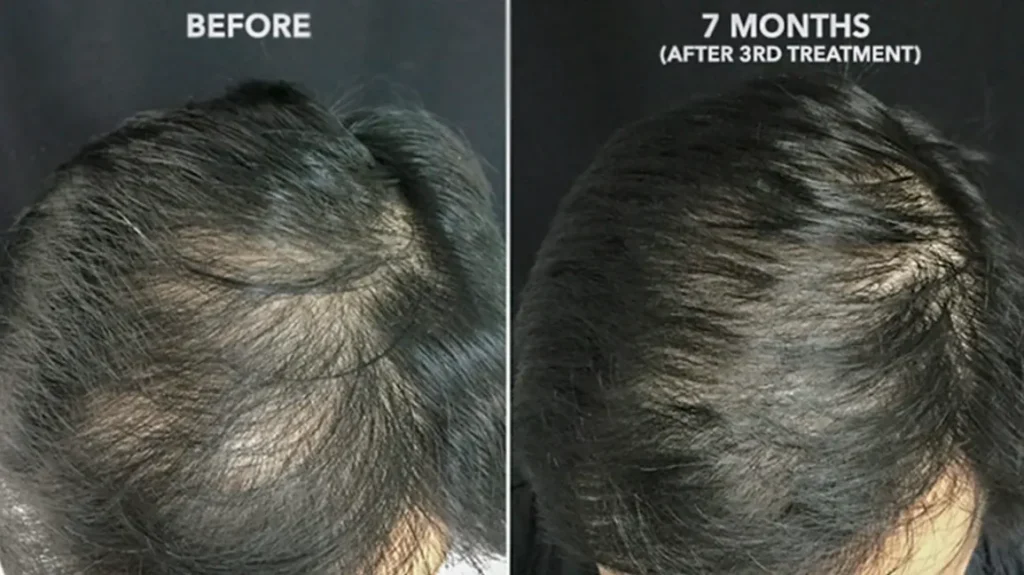 Platelet rich plasma treatment 1296x728 body 1296x728