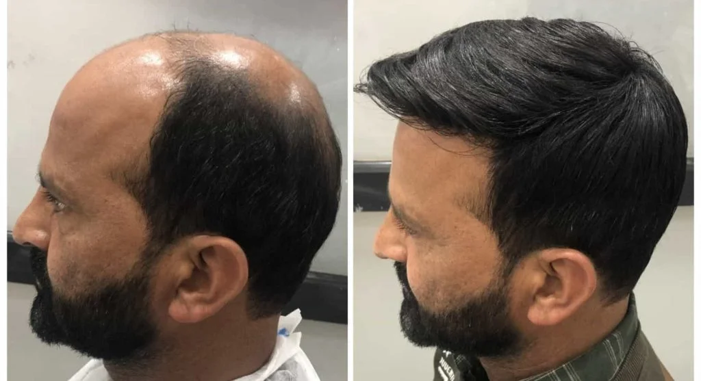 Best Hair Patch & Wig Treatment in Delhi – Modern Hair Replacement Solution
