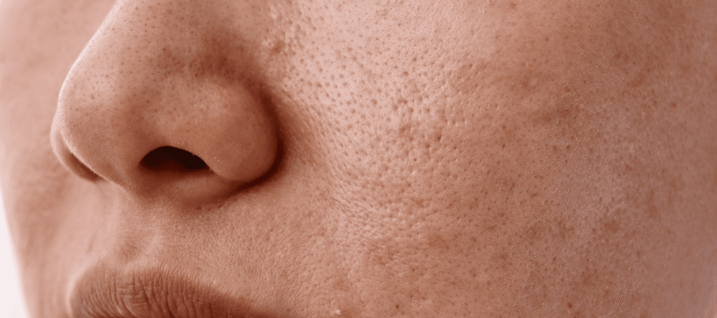 https://www.thepinkfoundry.com/cdn/shop/articles/Depicting_different_types_of_pitted_scars_on_the_skin_s_surface-min.png?v=1744710492&width=2048
