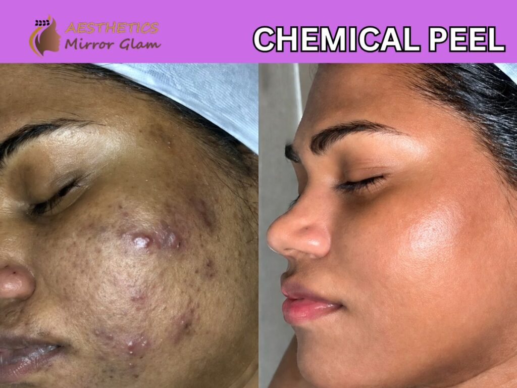 Chemical peel, chemicalpeel near me, chemical peel before & after