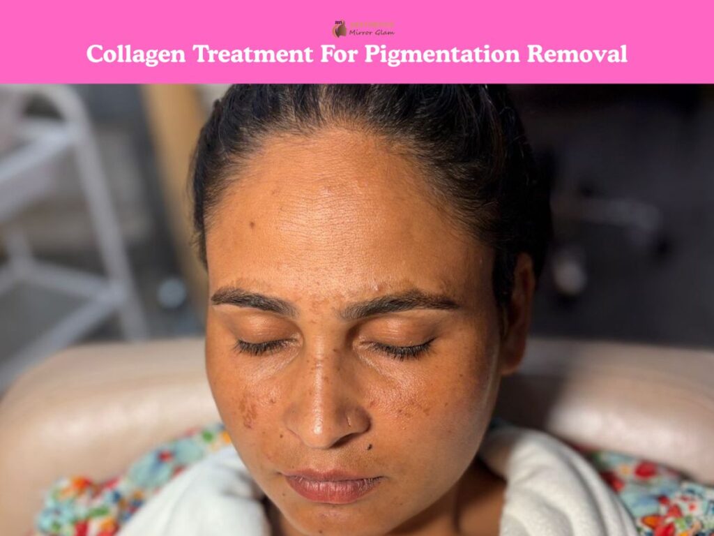 Collagen treatment for pigmentation removal