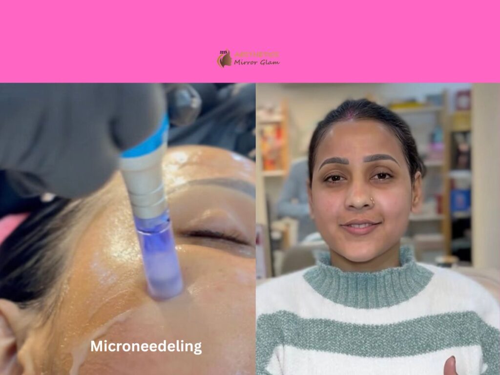 Microneedeling in rohini delhi 
