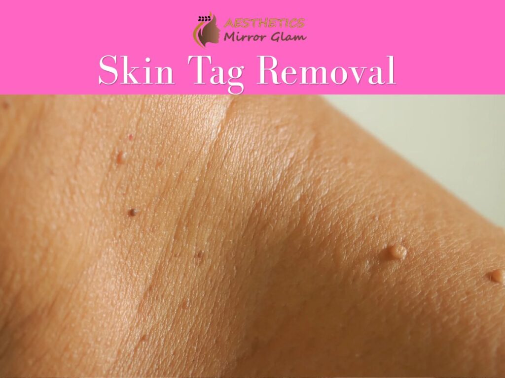 Mole Removal