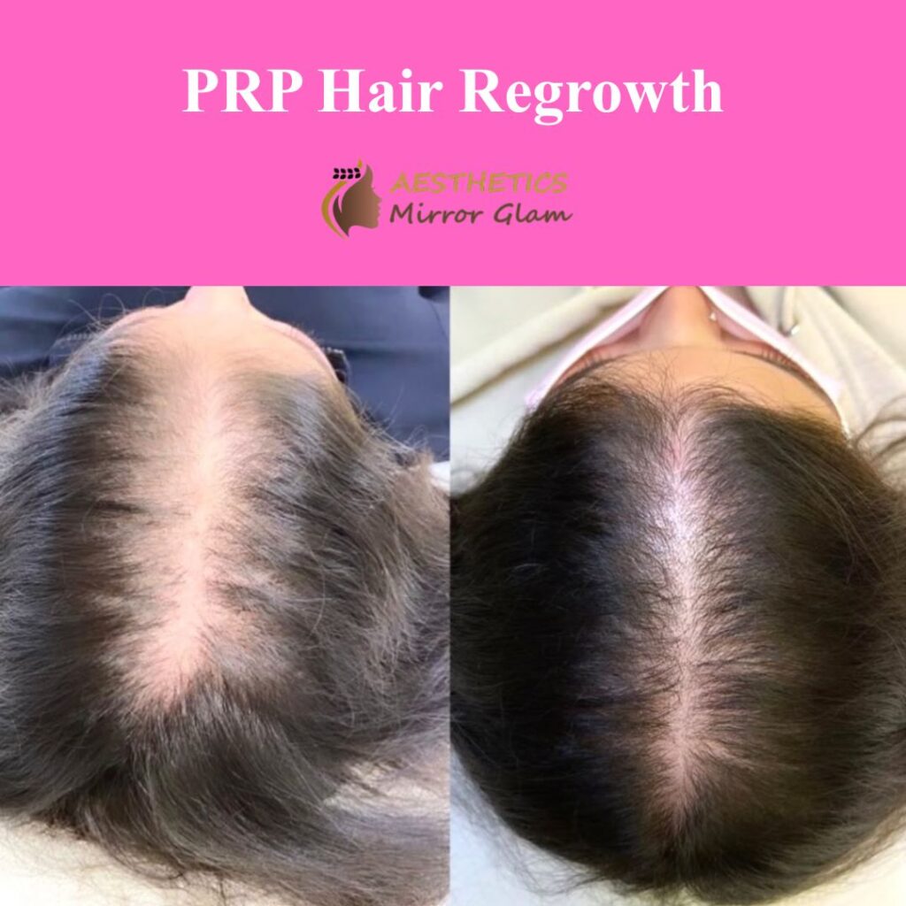 Best PRP Hair Treatment for Hair Fall in Rohini